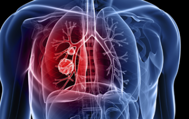 Existen varios contaminates carcinógenos, lo que quiere decir que inducen cáncer en el cuerpo de humanos y animales. Los contaminates carcinógenos son contaminantes que intervienen en una o más de las fases de desarrollo de cáncer en un organismo. Los contaminantes pueden ser inductores; esto significa que introducen propiedades cancerígenas en las células de un [&hellip;]